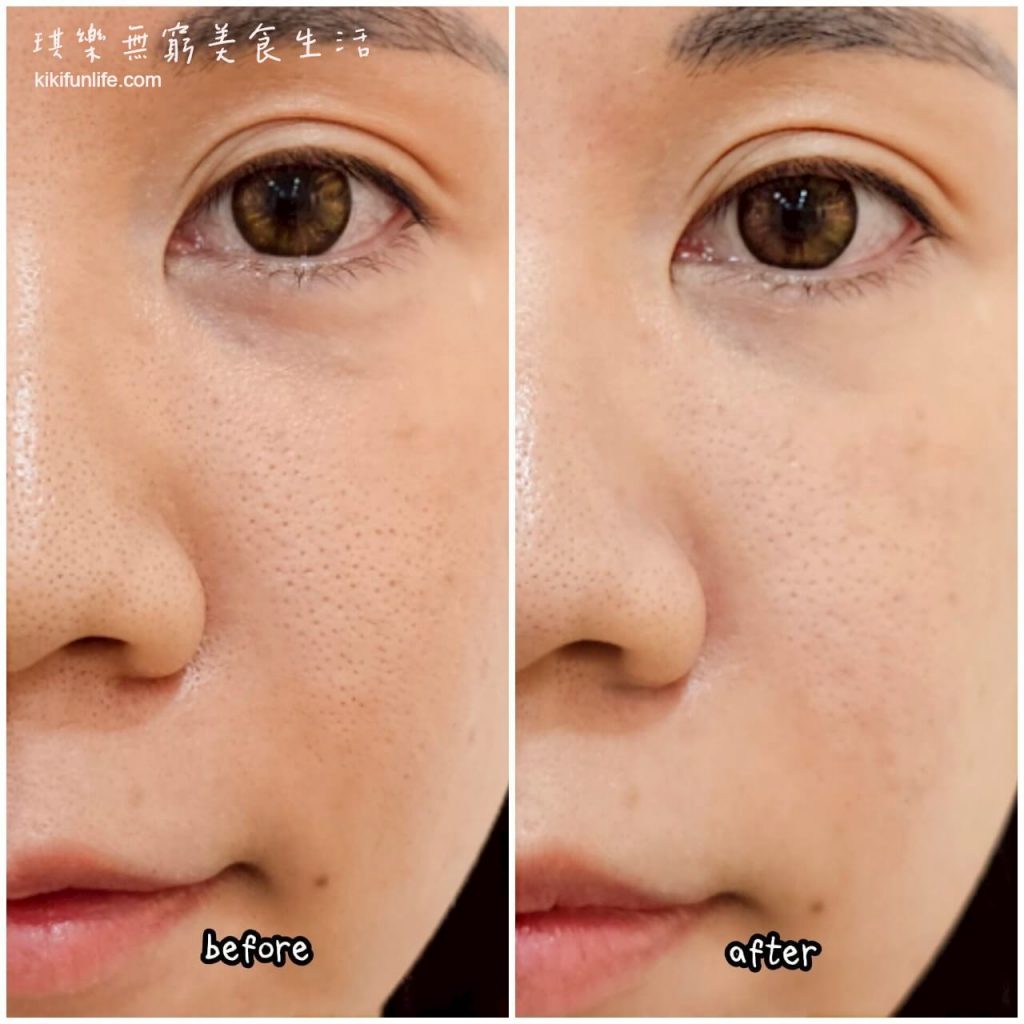 台中南屯洗臉貓_台中高CP值做臉_台中平價做臉_學生做臉_男生做臉_無痛清粉刺_台中做臉不推銷_南屯美容_台中美容推薦_台中平價護膚推薦_台中清粉刺推薦_台中美容院_嶺東做臉_前後對比圖_洗臉貓做臉效果評價