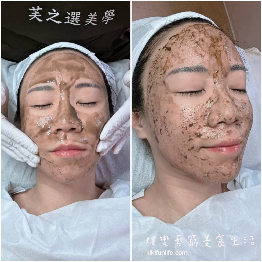 芙之選美學_海藻微針透亮管理_無痛清粉刺_按壓藻針